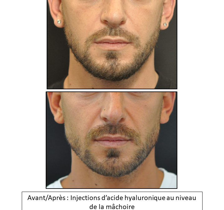 Masculinisation visage