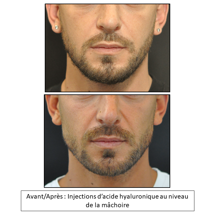 Masculinización facial