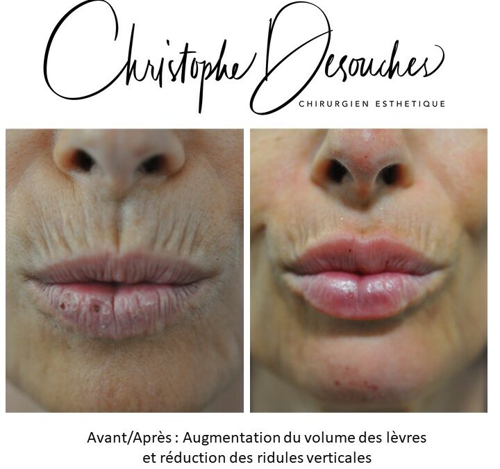 Hyaluronic acid mouth, treatment of vertical wrinkles and increase in lip volume