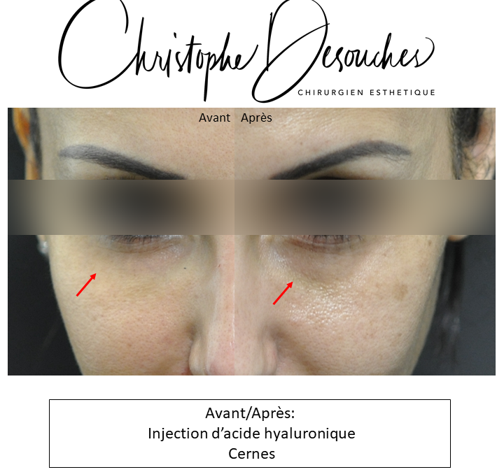 Hyaluronic acid dark circles