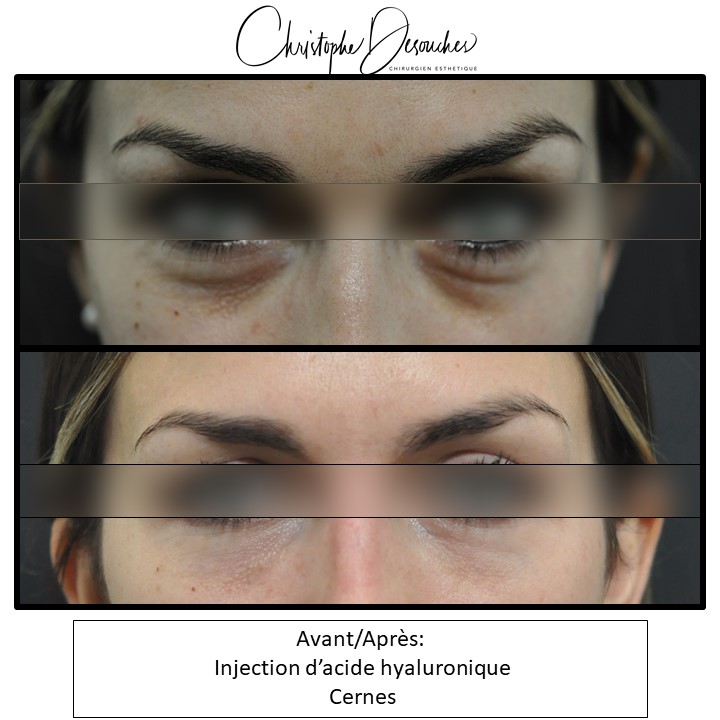 Injection of hyaluronic acid dark circles