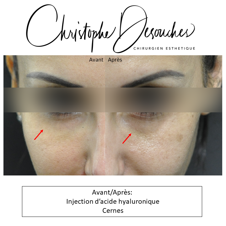 Hyaluronic acid dark circles