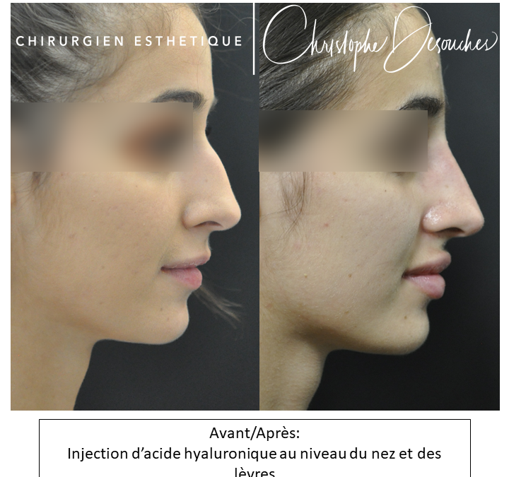 Medical profiloplasty