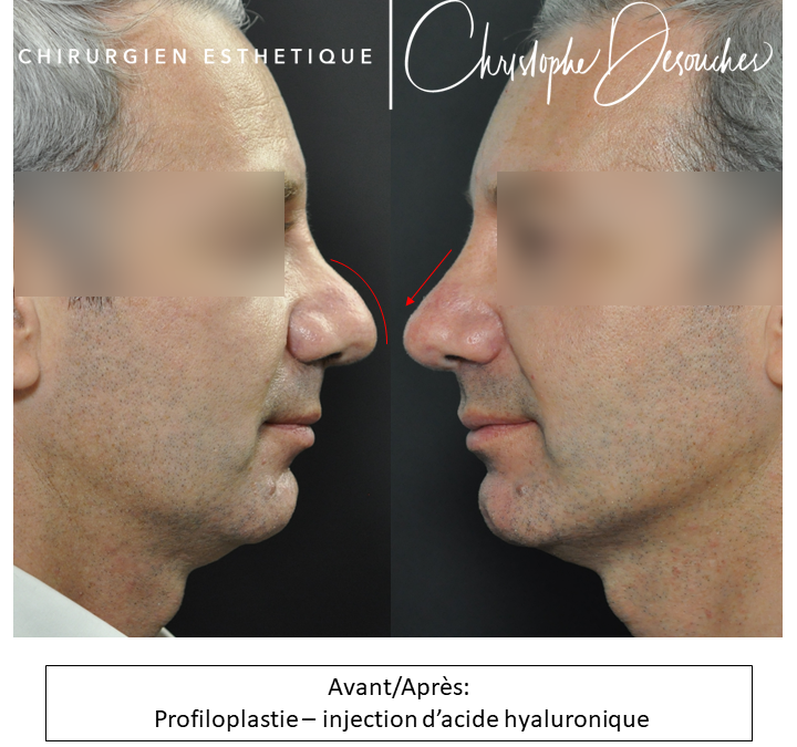 Hyaluronic acid injection