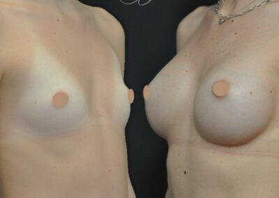 Breast prostheses