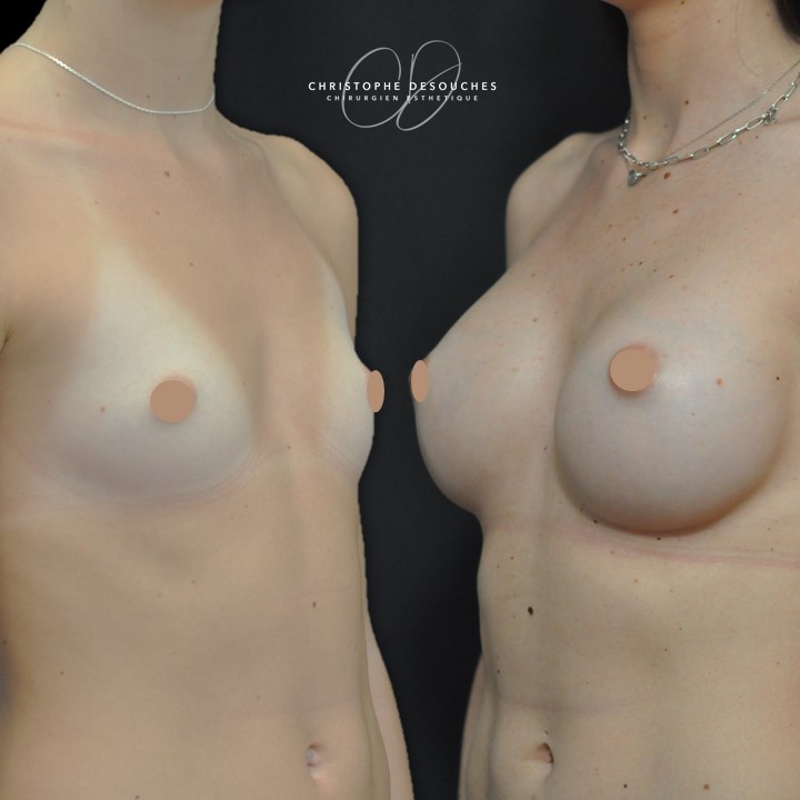 Breast prostheses