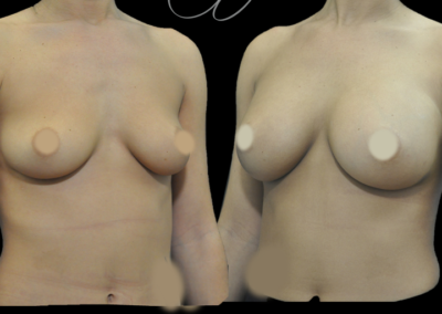 Aumento de senos mediante prótesis