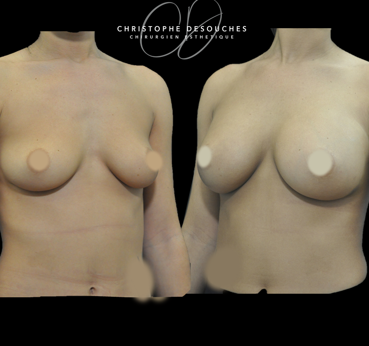Breast augmentation with prostheses