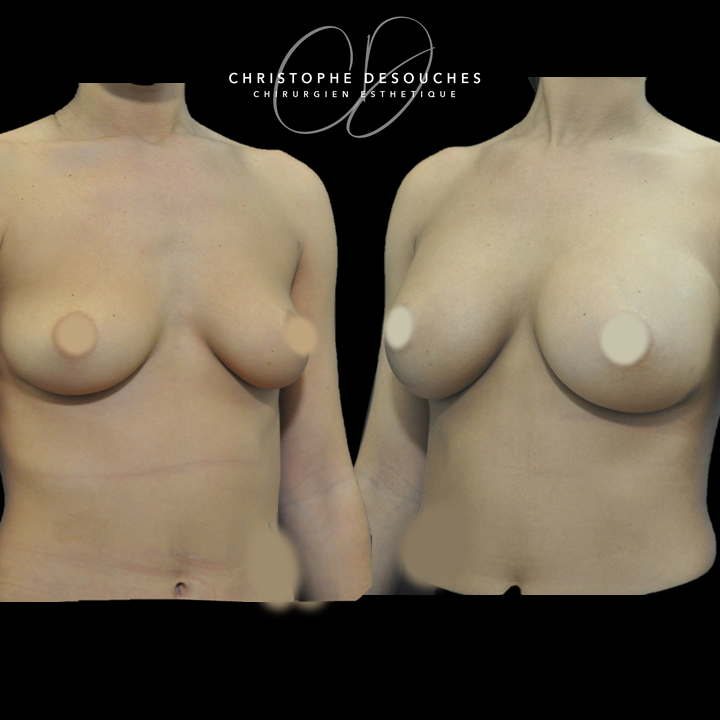 Breast augmentation with prostheses