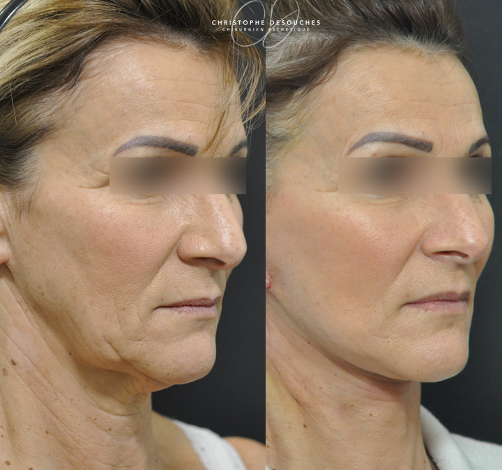 Cervico-Facial lifting