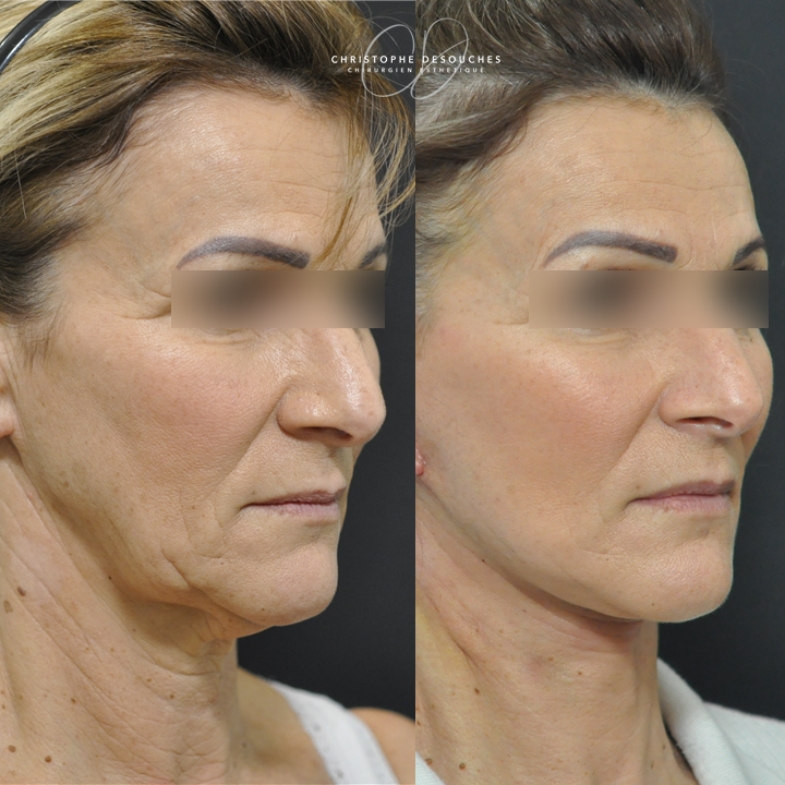 Lifting Cervico-Facial