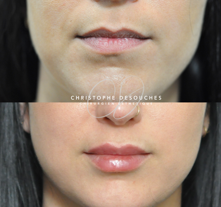 Lip injection