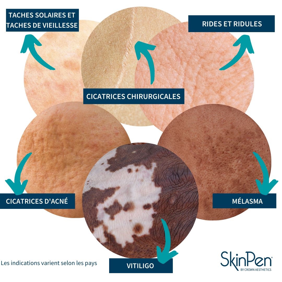 SkinPen microneedling indicazioni cicatrici da acne della pelle