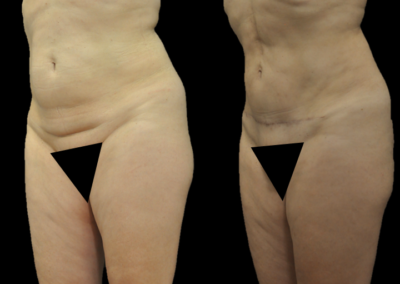 Abdominoplastia