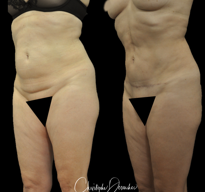 Abdominoplastie avant après