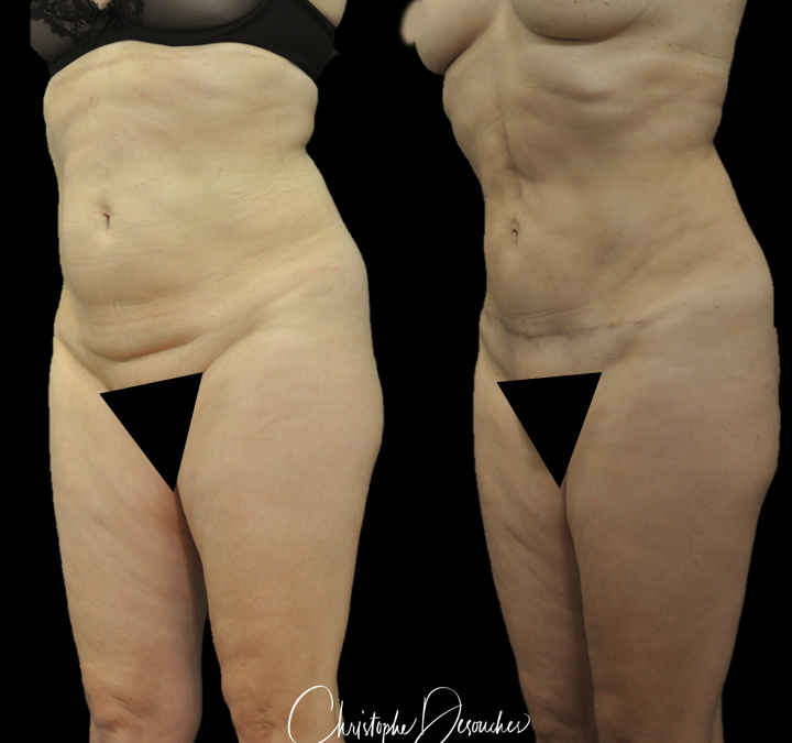 Abdominoplastia