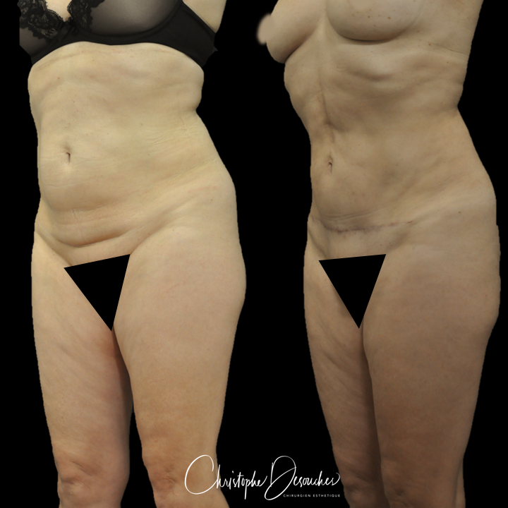 Abdominoplastie