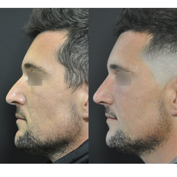 Perfiloplastia médica masculina