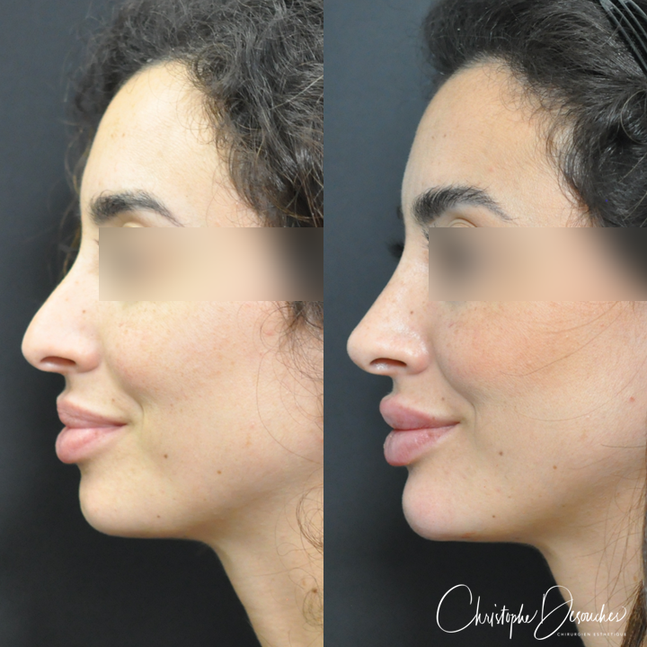 Medical rhinoplasty in Marseille, before after