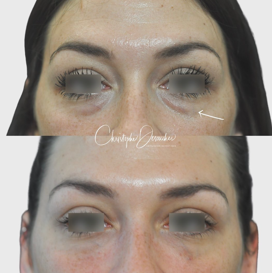 Hyaluronic acid dark circles