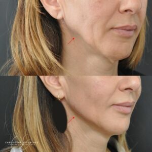 jawline contouring woman 