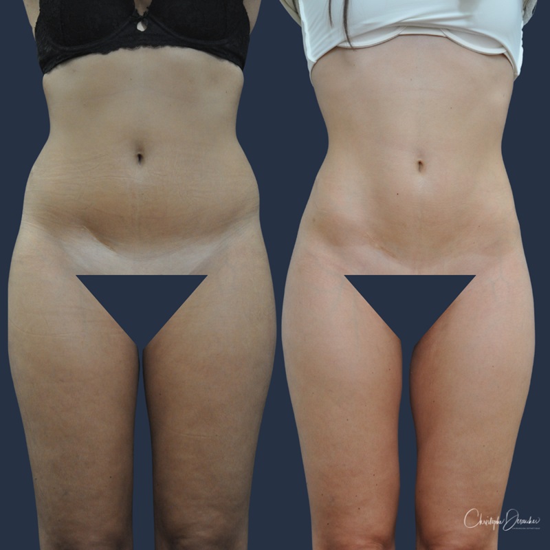 ultrasound liposuction for the silhouette