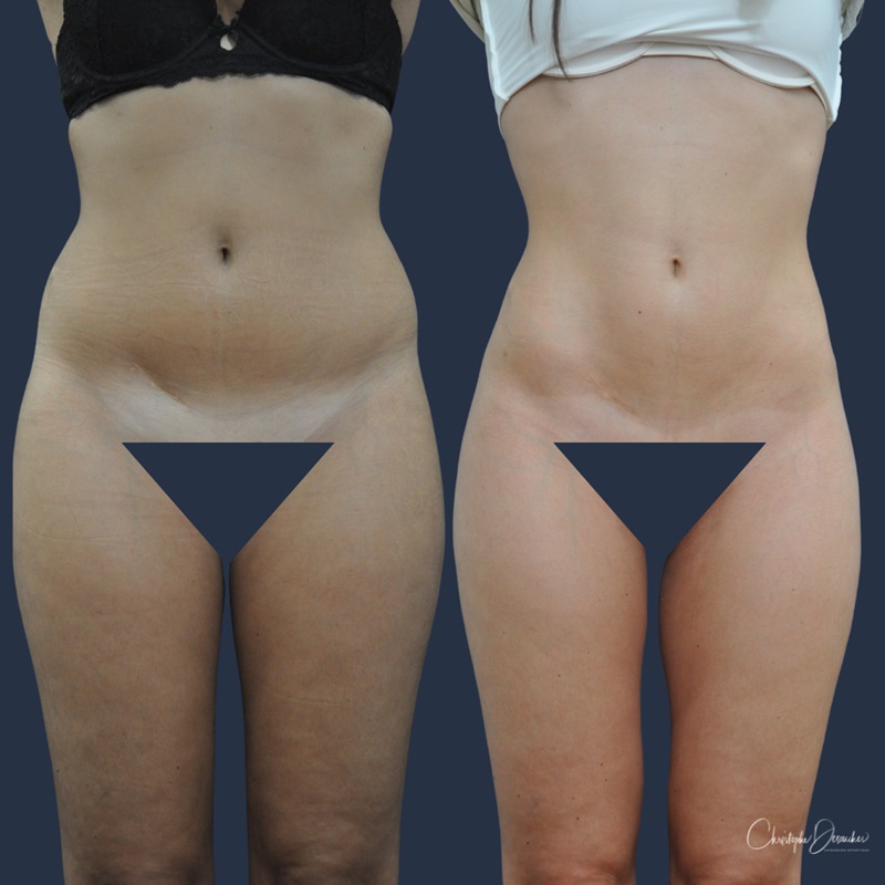 liposuccion par ultrason pour la silhouette