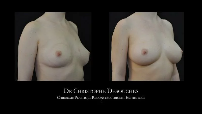 natural breast augmentation lipofilling