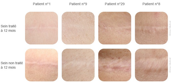 urgotouch laser phototype all skin types