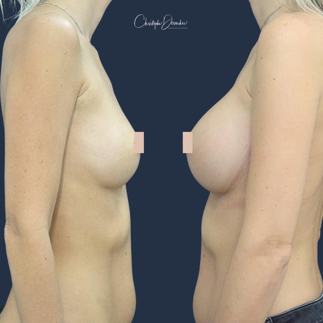 Antes y después del aumento de senos con implantes, vista de perfil: aumento de volumen y proyección.