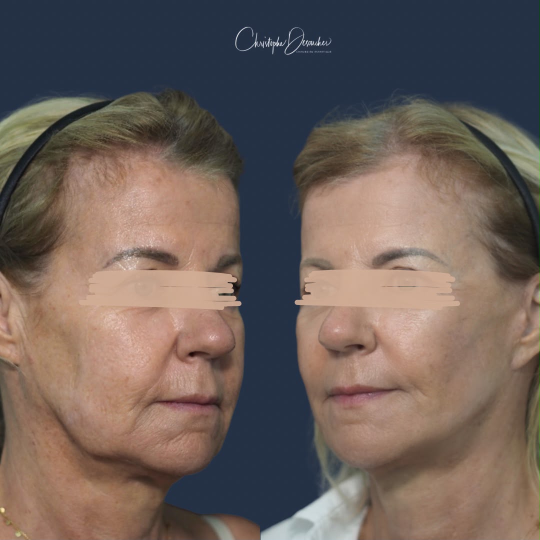 Before/after French Lift, minimally invasive facelift: redefined facial oval, reduced jowls and neck, 3/4 view