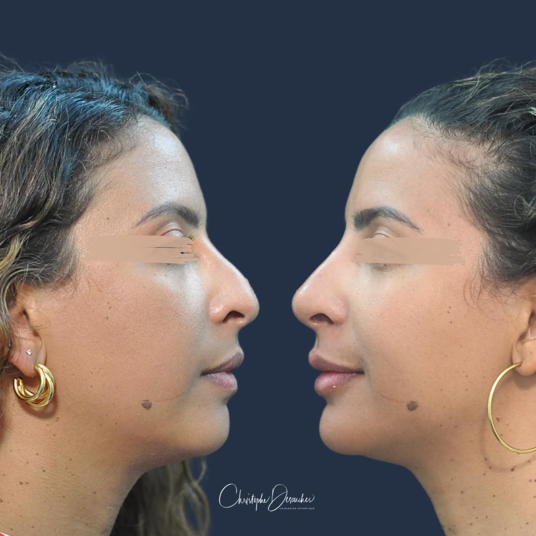 Avant/après profiloplastie médicale par injection, sans chirurgie : bosse du nez atténuée et profil harmonisé, vue de profil