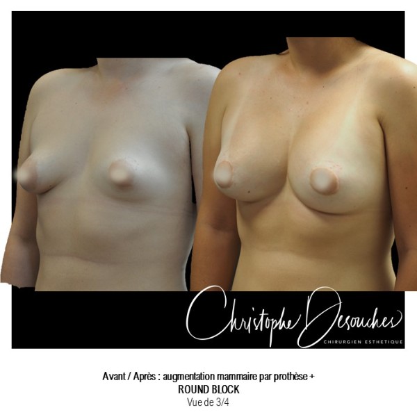 Breast augmentation with prostheses - periareolar route: Round block