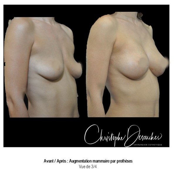 Breast prostheses