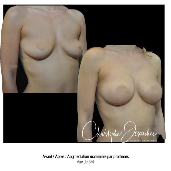 Breast prostheses