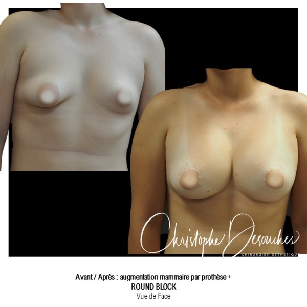 Breast prostheses and round block