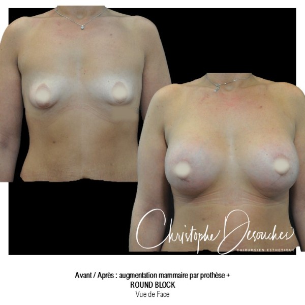Breast augmentation with prostheses and round block
