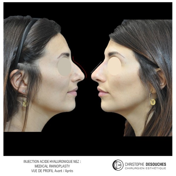 Médicale rhinoplastie : injection d'acide hyaluronique 