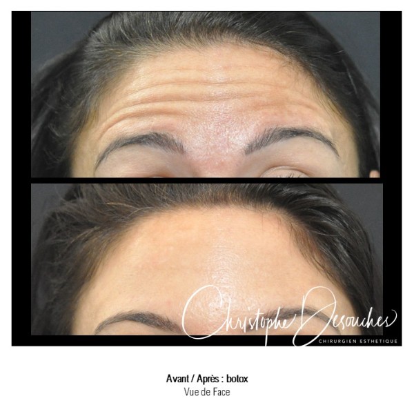 Botulinum toxin injections in the forehead - Reducing expression lines with botox