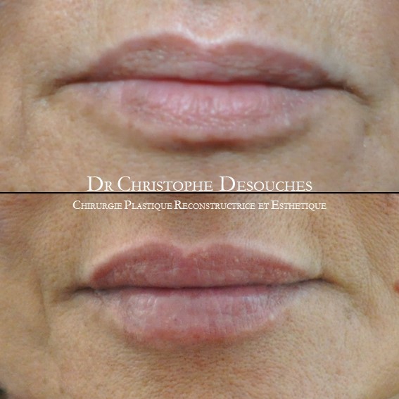 lip augmentation