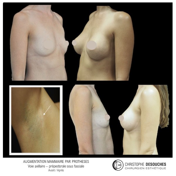 Aumento mamario mediante prótesis, abordaje axilar, prepectoral y subfascial