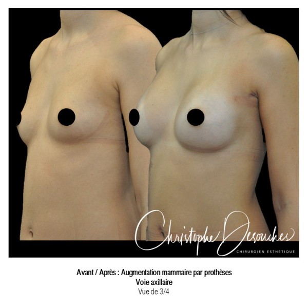 Augmentation mammaire par prothese par voie axillaire