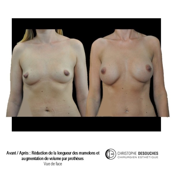 Reduction in the size of the nipple associated with breast enlargement by prostheses