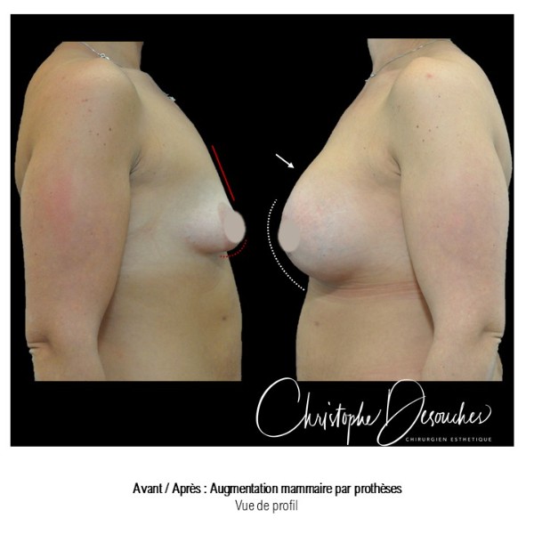 Augmentation mammaire par prothèses - voie périaréolaire