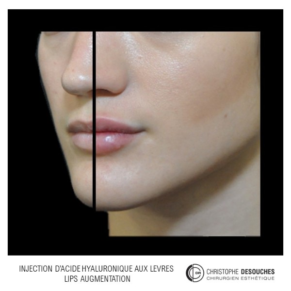 Lip augmentation by injection of Hyaluronic Acid