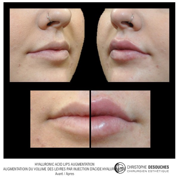 Augmentation du volume des lèvres par injection d'acide hyaluronique