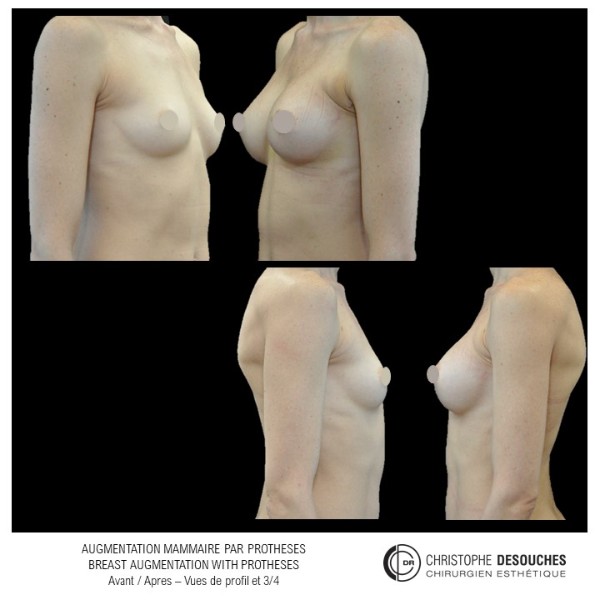 Breast augmentation by axillary prosthesis