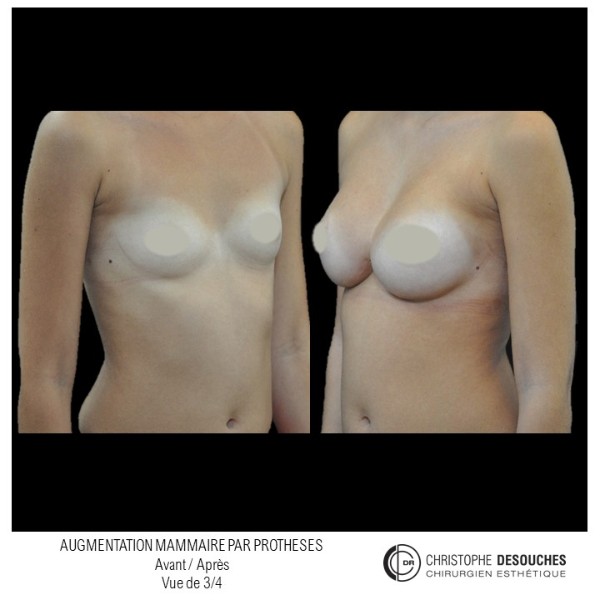 breast augmentation by prosthesis