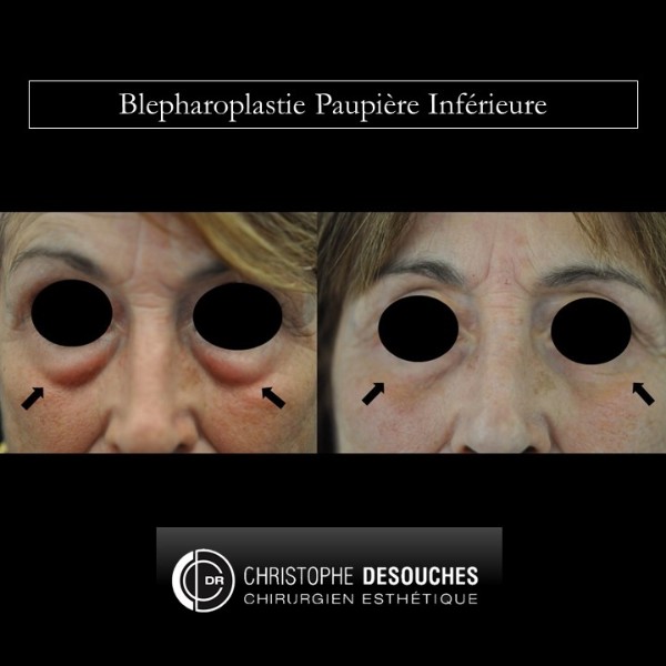 Blepharoplastie paupière inférieure