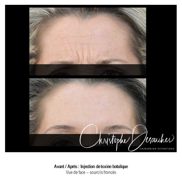 Botulinum toxin injections in the forehead - Erase expression lines